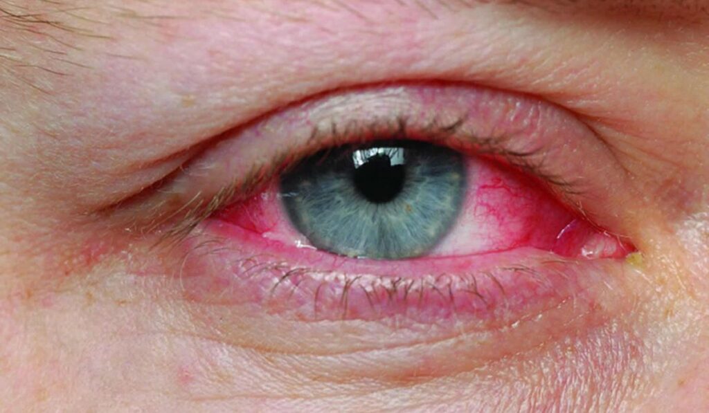 conjunctivitis