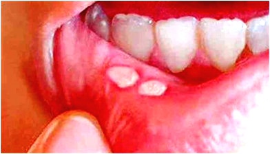 Mouth ulcer remedies at home: ये आसान नुस्खों से आप मुंह के छालों से पा सकते हैं तुरंत मुक्ति